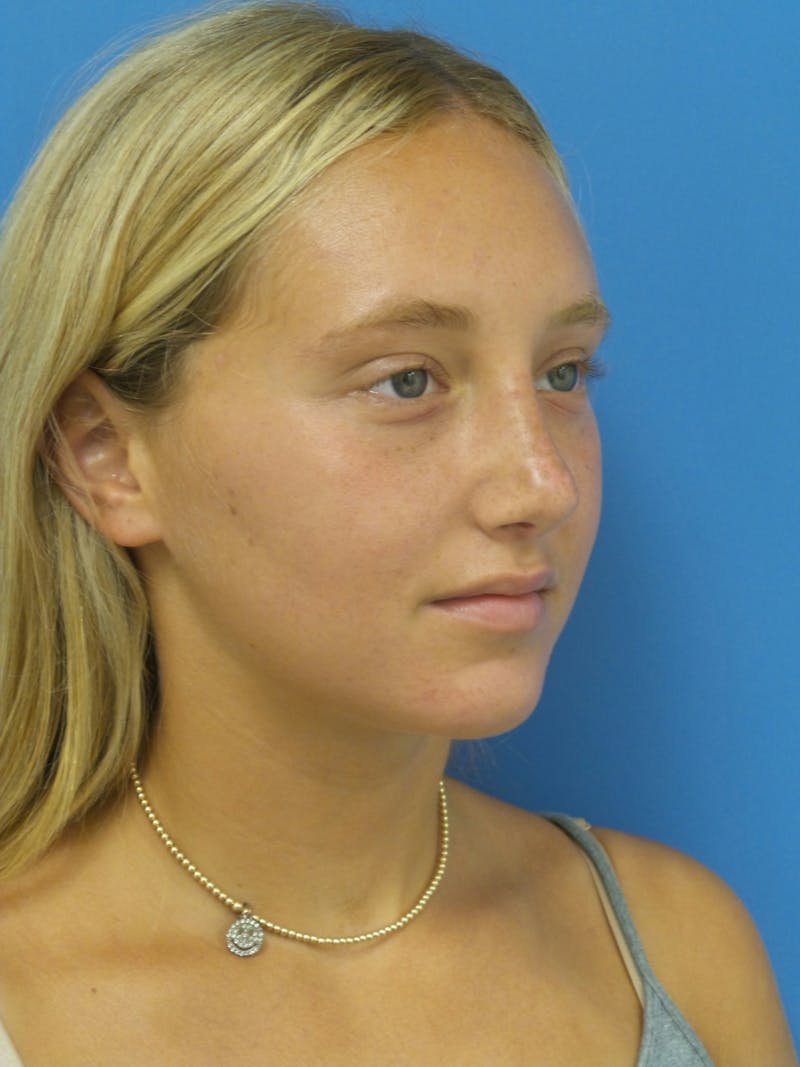 Rhinoplasty Before & After Gallery - Patient 178538 - Image 4