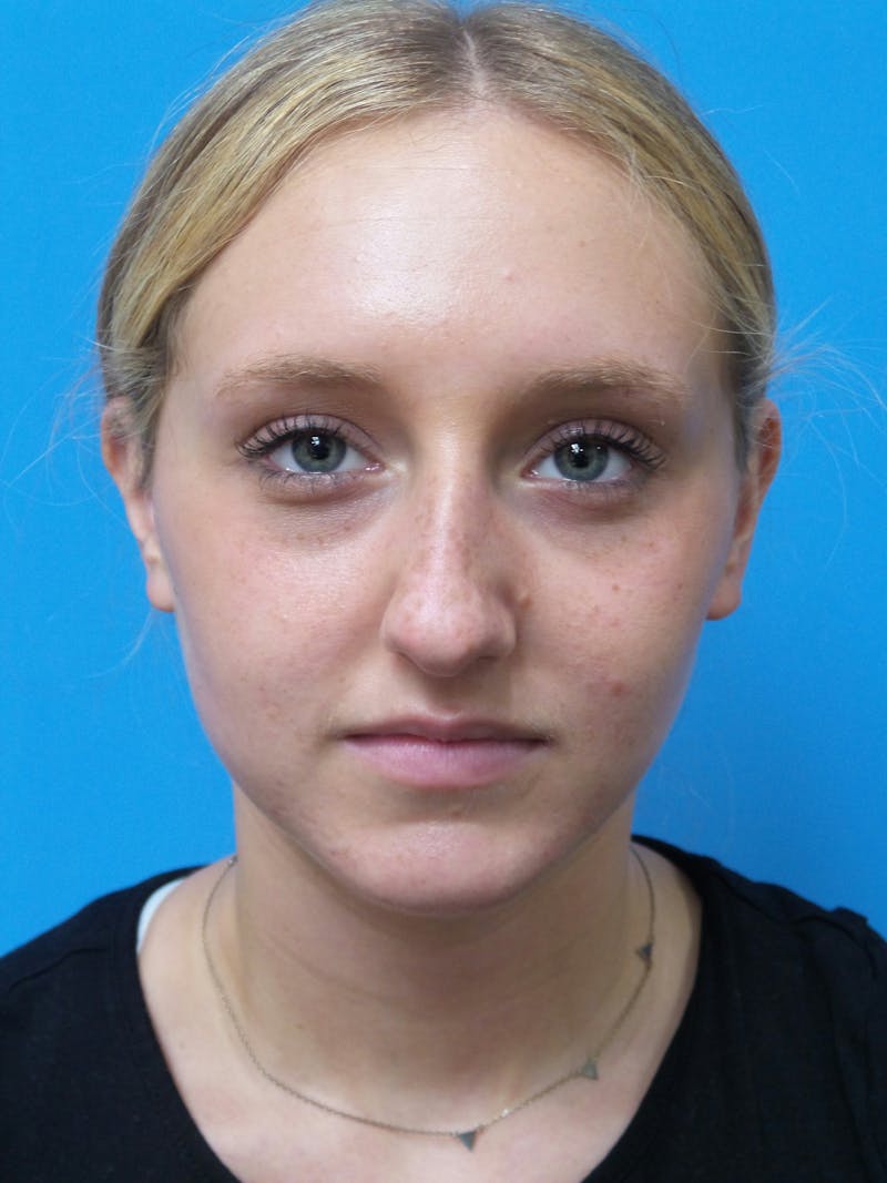 Rhinoplasty Before & After Gallery - Patient 178538 - Image 5