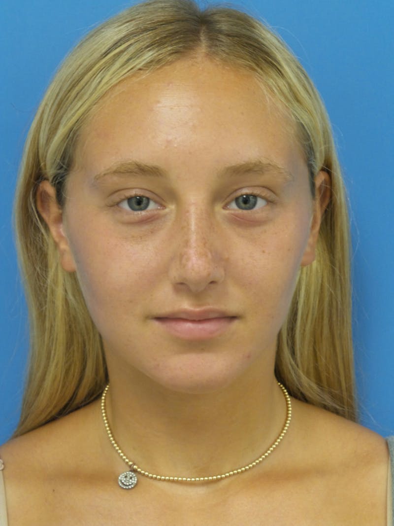 Rhinoplasty Before & After Gallery - Patient 178538 - Image 6