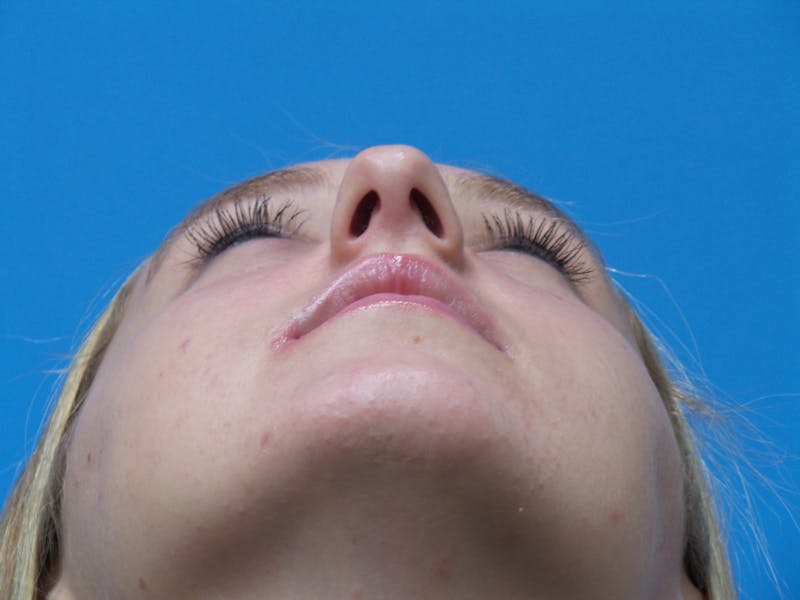 Rhinoplasty Before & After Gallery - Patient 178538 - Image 7