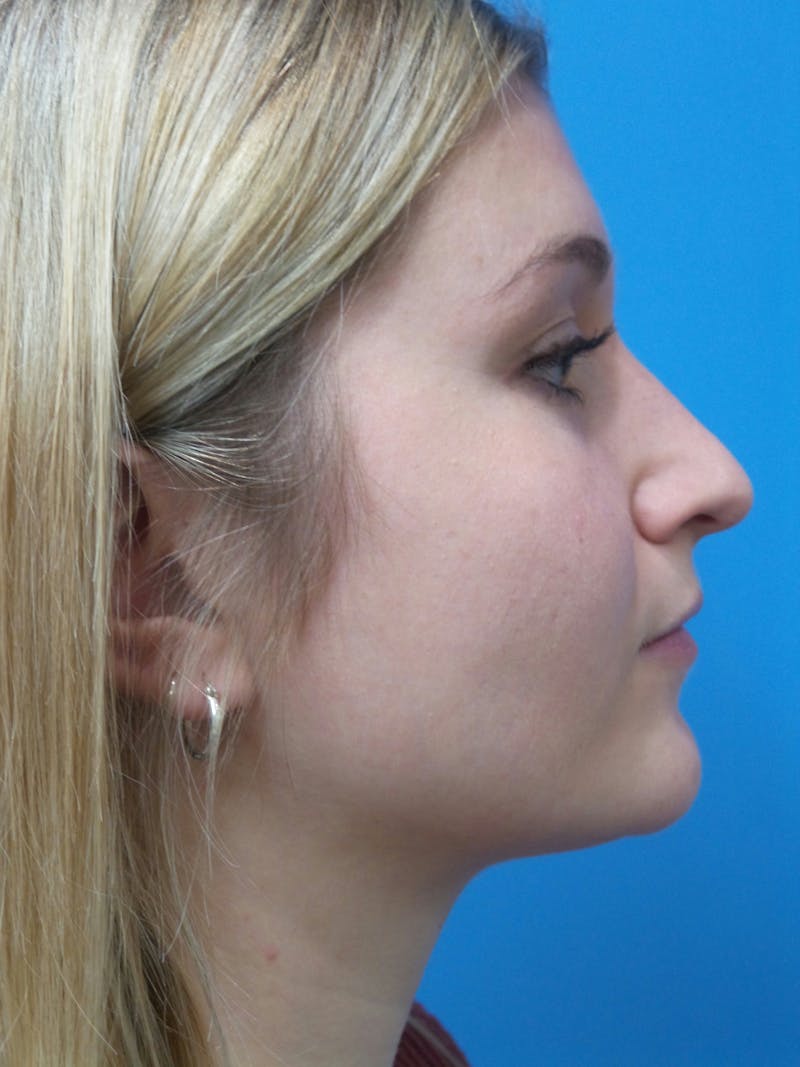 Rhinoplasty Before & After Gallery - Patient 327955 - Image 1