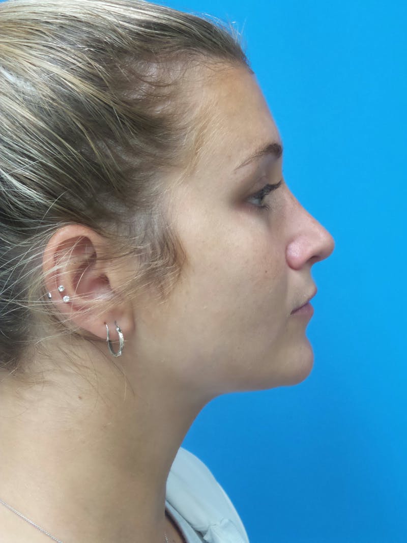 Rhinoplasty Before & After Gallery - Patient 327955 - Image 2