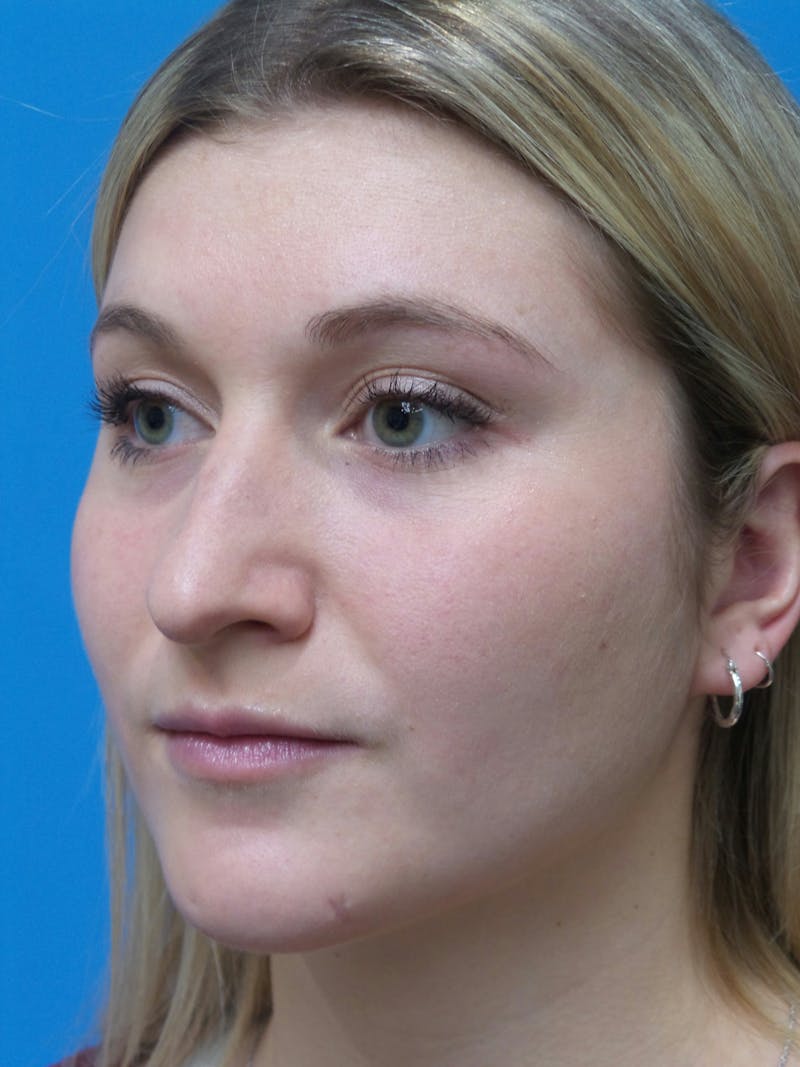 Rhinoplasty Before & After Gallery - Patient 327955 - Image 3
