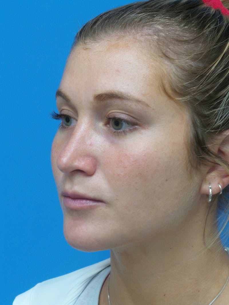 Rhinoplasty Before & After Gallery - Patient 327955 - Image 4