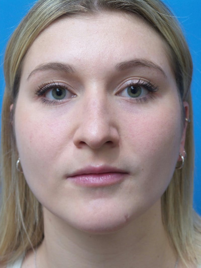 Rhinoplasty Before & After Gallery - Patient 327955 - Image 5