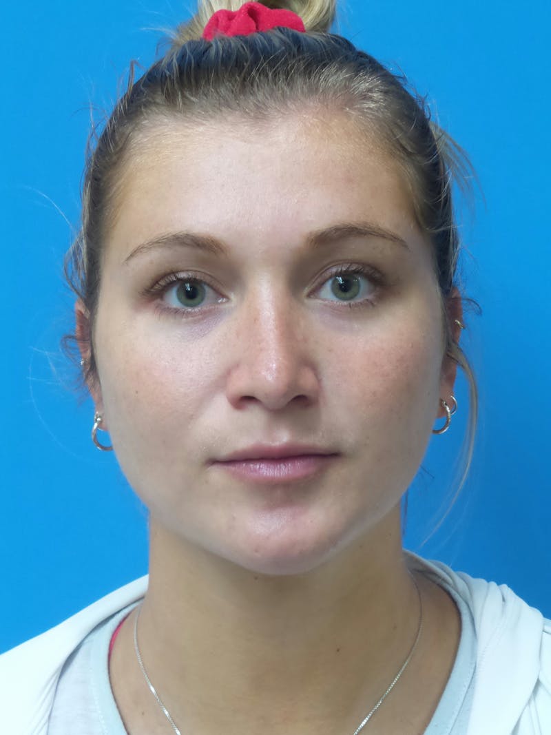 Rhinoplasty Before & After Gallery - Patient 327955 - Image 6