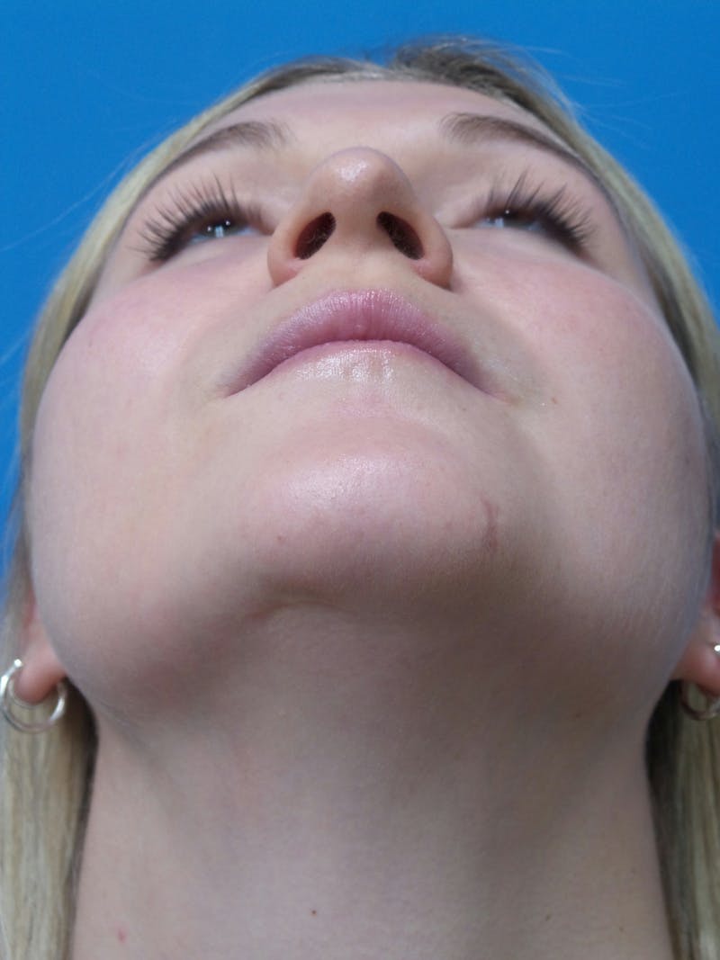 Rhinoplasty Before & After Gallery - Patient 327955 - Image 7