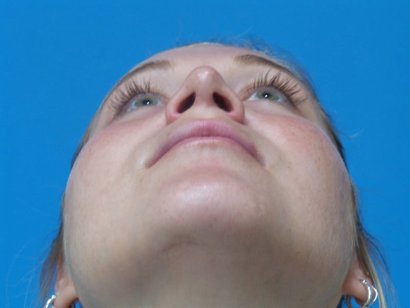 Rhinoplasty Before & After Gallery - Patient 327955 - Image 8