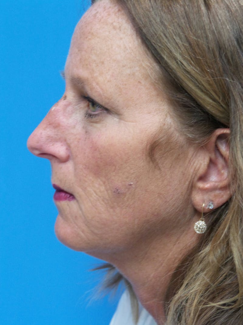 Rhinoplasty Before & After Gallery - Patient 982890 - Image 1