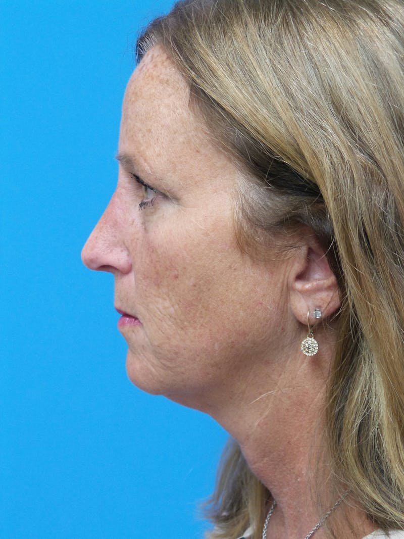 Rhinoplasty Before & After Gallery - Patient 982890 - Image 2
