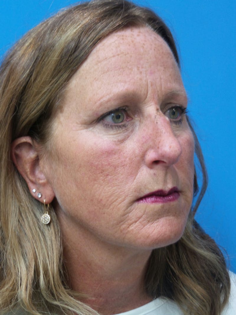 Rhinoplasty Before & After Gallery - Patient 982890 - Image 3