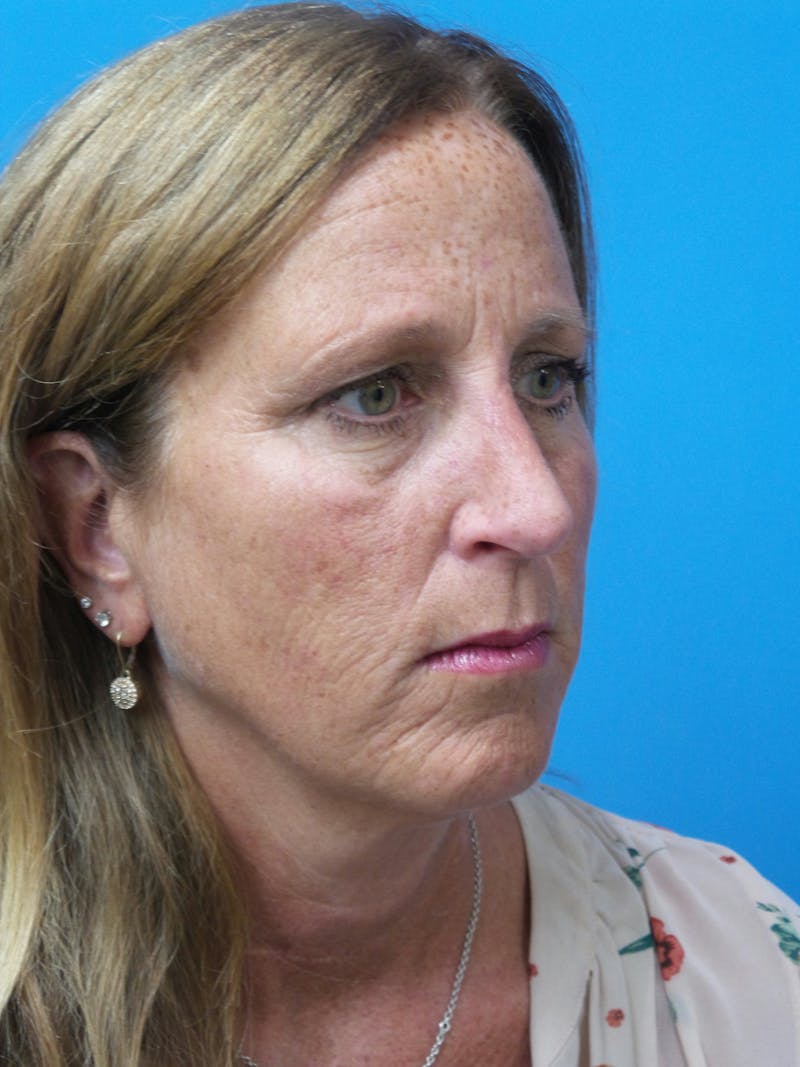 Rhinoplasty Before & After Gallery - Patient 982890 - Image 4