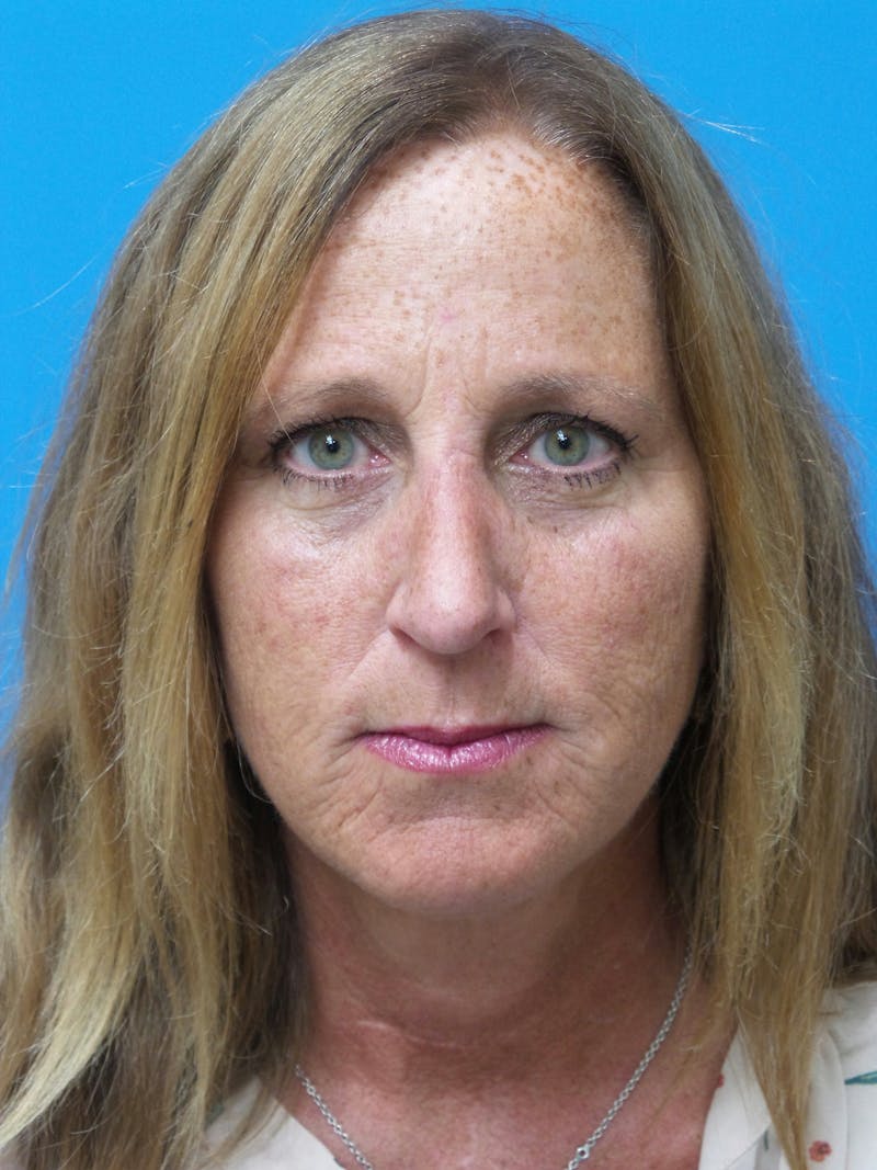 Rhinoplasty Before & After Gallery - Patient 982890 - Image 6