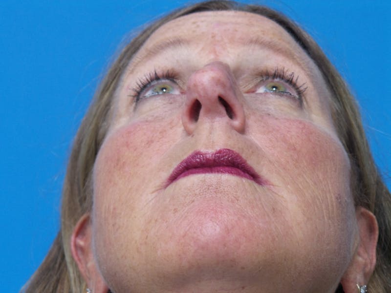 Rhinoplasty Before & After Gallery - Patient 982890 - Image 7