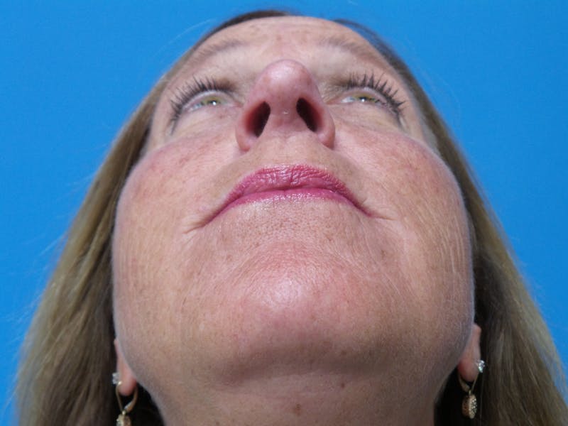 Rhinoplasty Before & After Gallery - Patient 982890 - Image 8