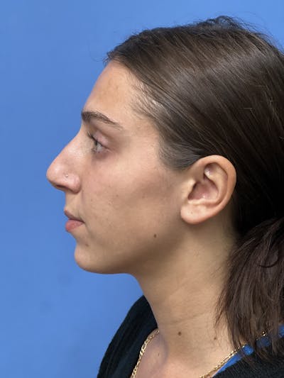 Rhinoplasty Before & After Gallery - Patient 291914 - Image 1