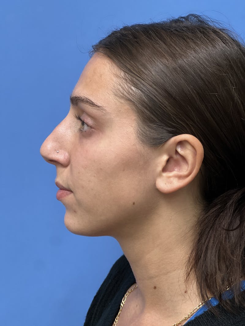 Rhinoplasty Before & After Gallery - Patient 291914 - Image 1