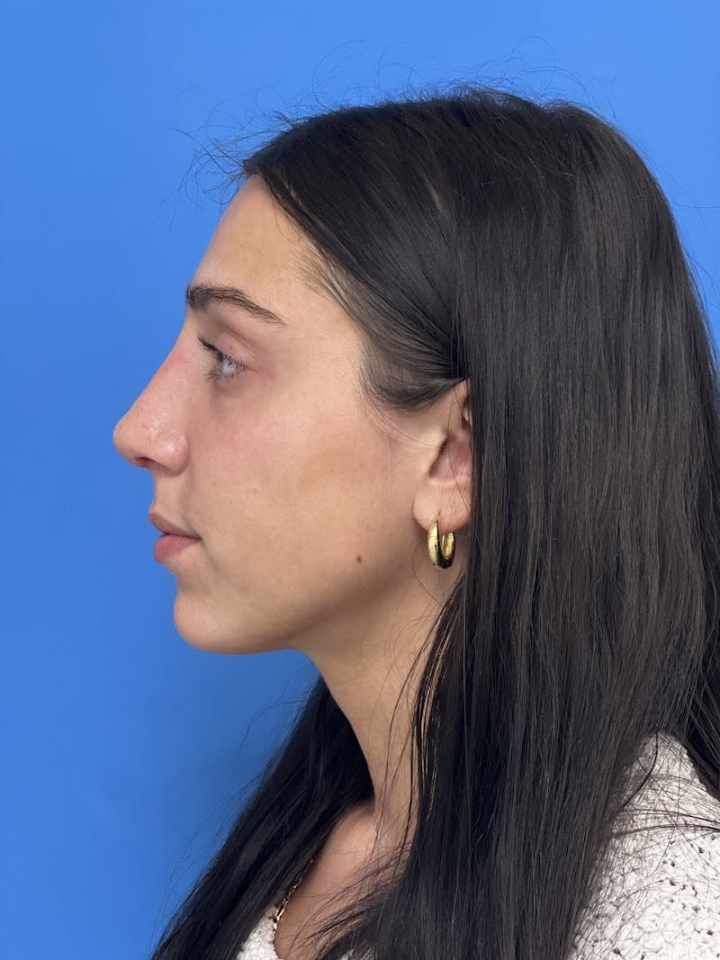 Rhinoplasty Before & After Gallery - Patient 291914 - Image 2