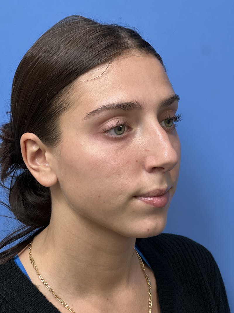 Rhinoplasty Before & After Gallery - Patient 291914 - Image 3