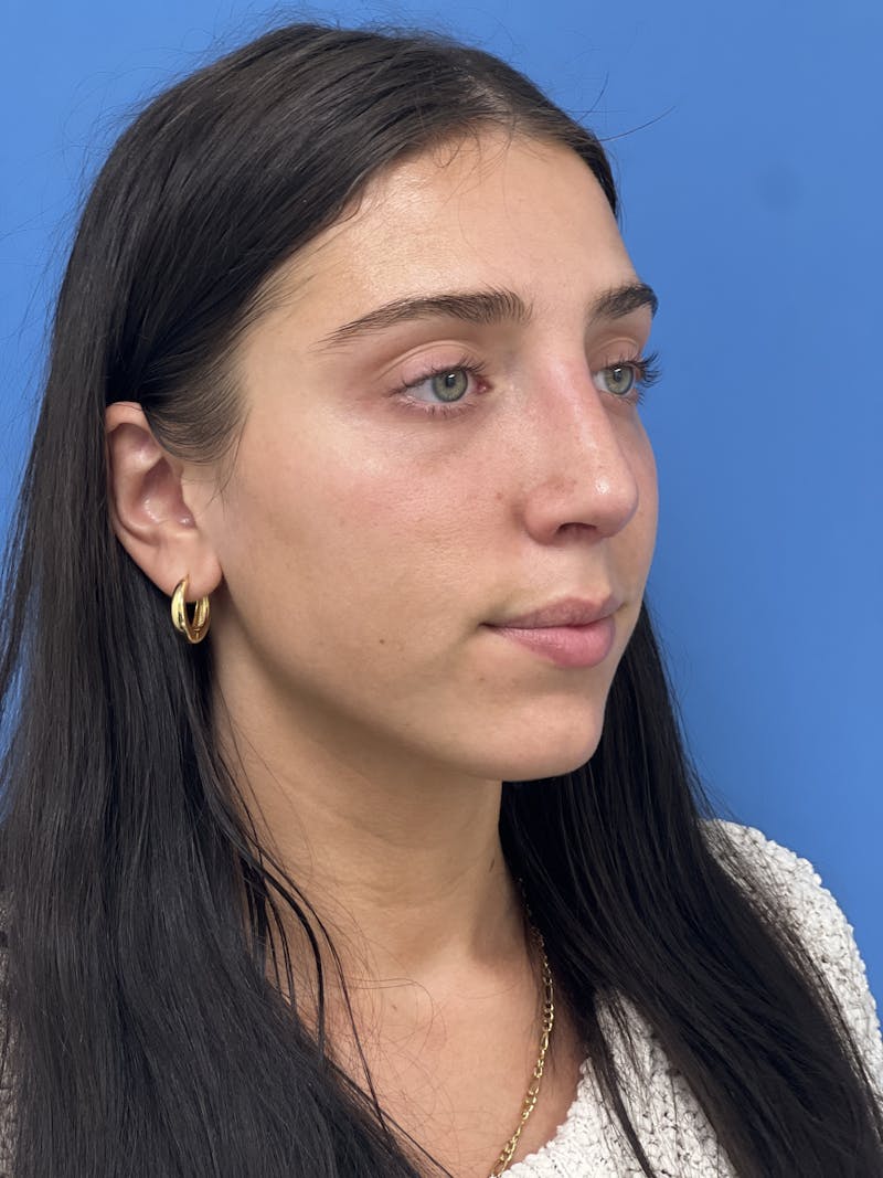 Rhinoplasty Before & After Gallery - Patient 291914 - Image 4