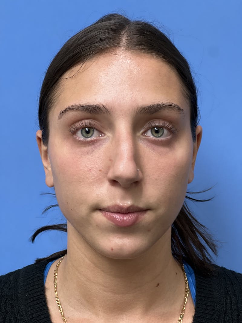 Rhinoplasty Before & After Gallery - Patient 291914 - Image 5