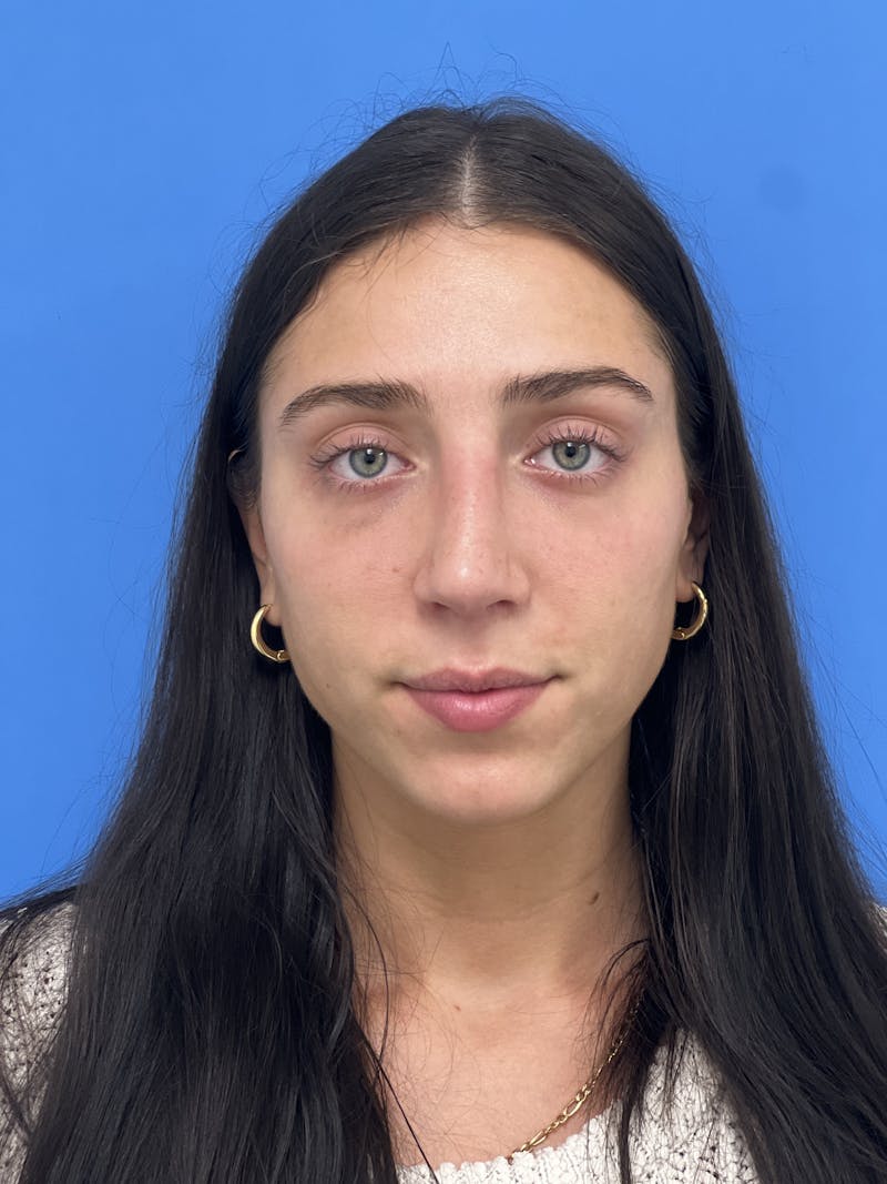 Rhinoplasty Before & After Gallery - Patient 291914 - Image 6