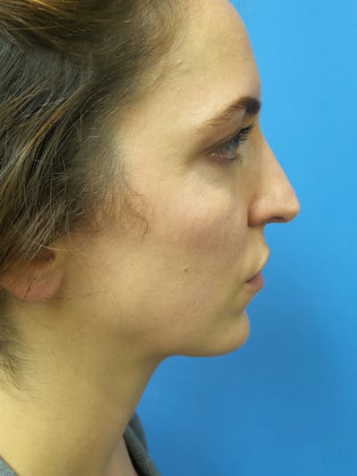 Rhinoplasty Before & After Gallery - Patient 205885 - Image 1