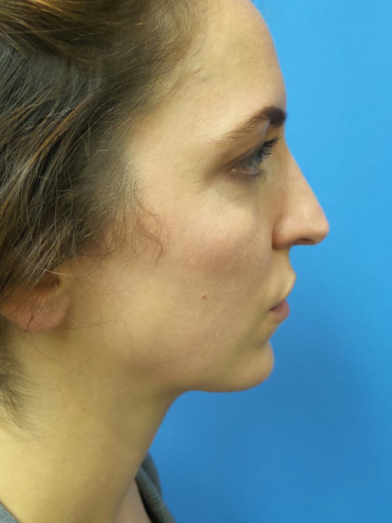 Rhinoplasty Before & After Gallery - Patient 205885 - Image 1