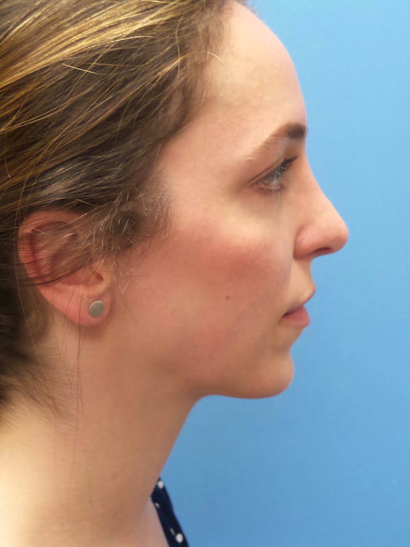 Rhinoplasty Before & After Gallery - Patient 205885 - Image 2