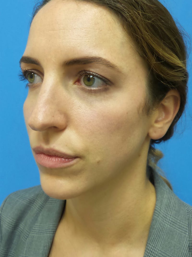 Rhinoplasty Before & After Gallery - Patient 205885 - Image 3