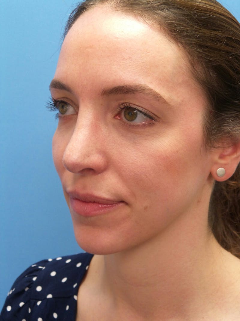 Rhinoplasty Before & After Gallery - Patient 205885 - Image 4