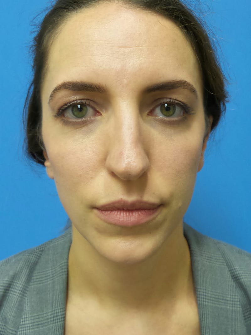 Rhinoplasty Before & After Gallery - Patient 205885 - Image 5