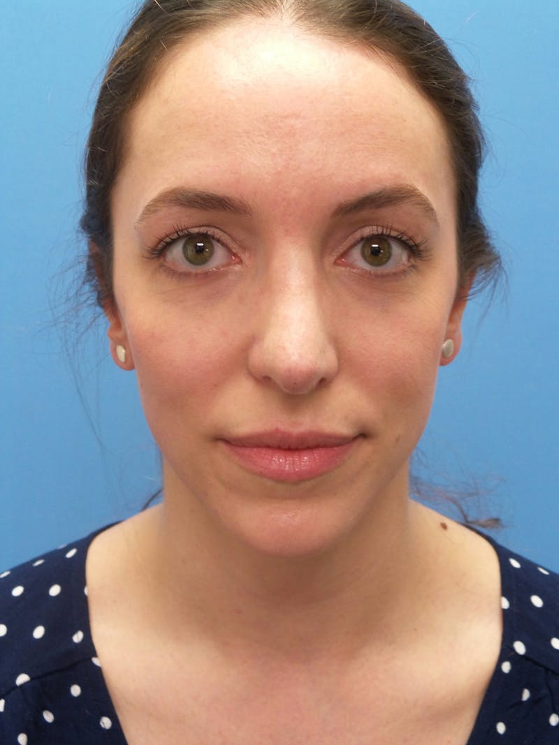 Rhinoplasty Before & After Gallery - Patient 205885 - Image 6