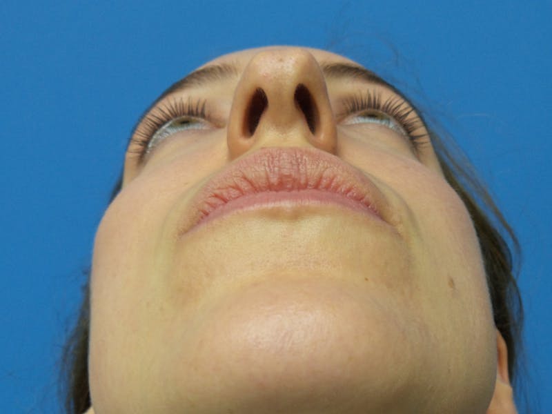 Rhinoplasty Before & After Gallery - Patient 205885 - Image 7