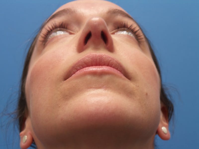 Rhinoplasty Before & After Gallery - Patient 205885 - Image 8