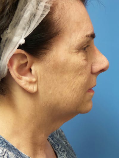 Rhinoplasty Before & After Gallery - Patient 338039 - Image 1