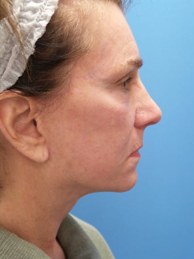Rhinoplasty Before & After Gallery - Patient 338039 - Image 2