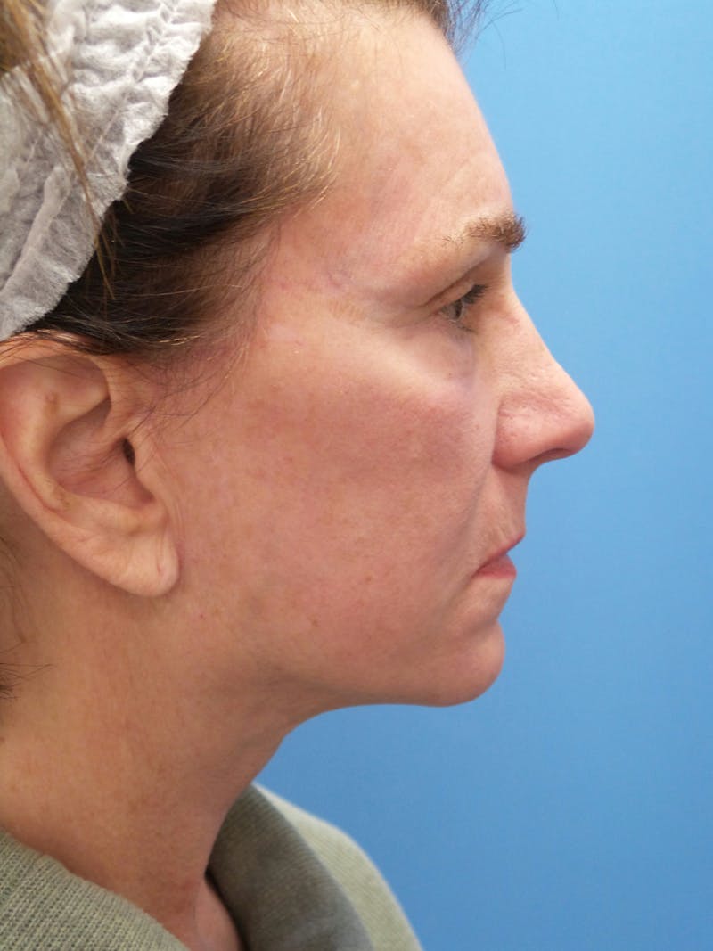 Rhinoplasty Before & After Gallery - Patient 338039 - Image 2