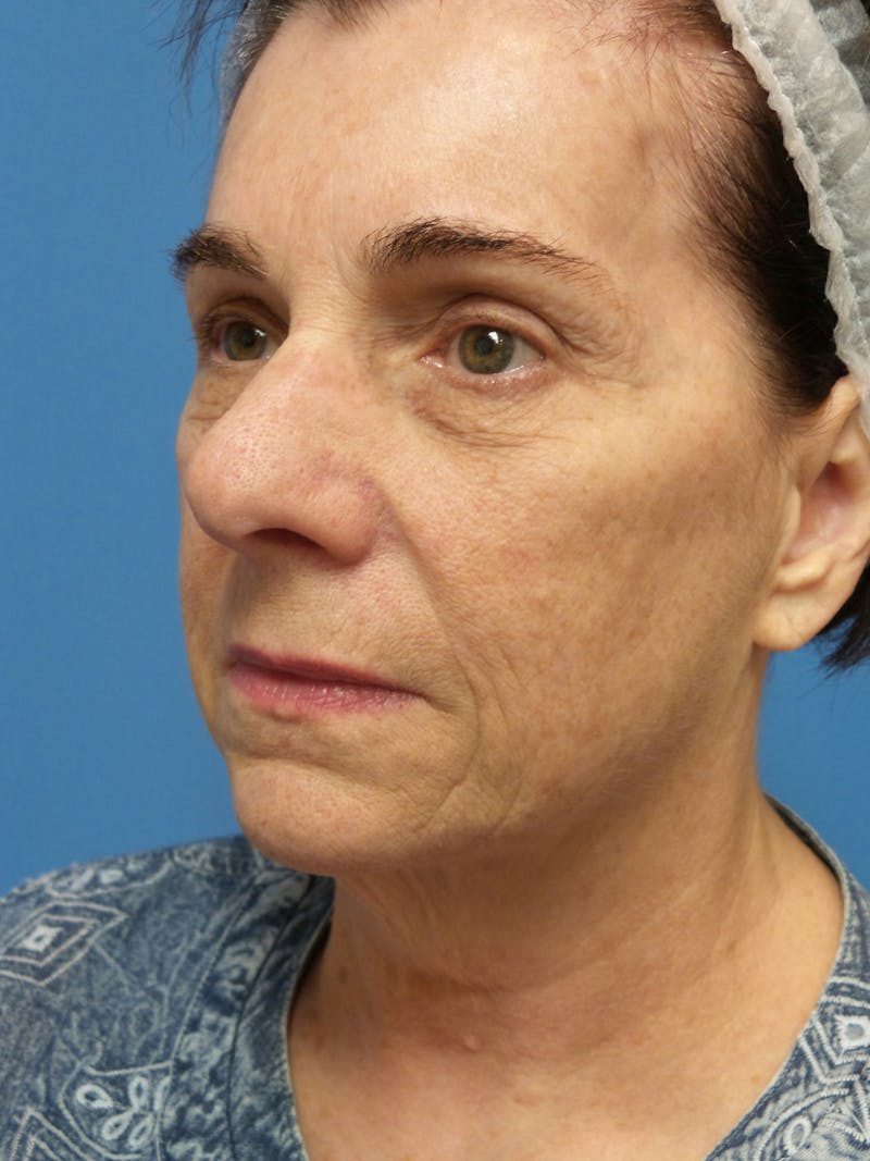Rhinoplasty Before & After Gallery - Patient 338039 - Image 3