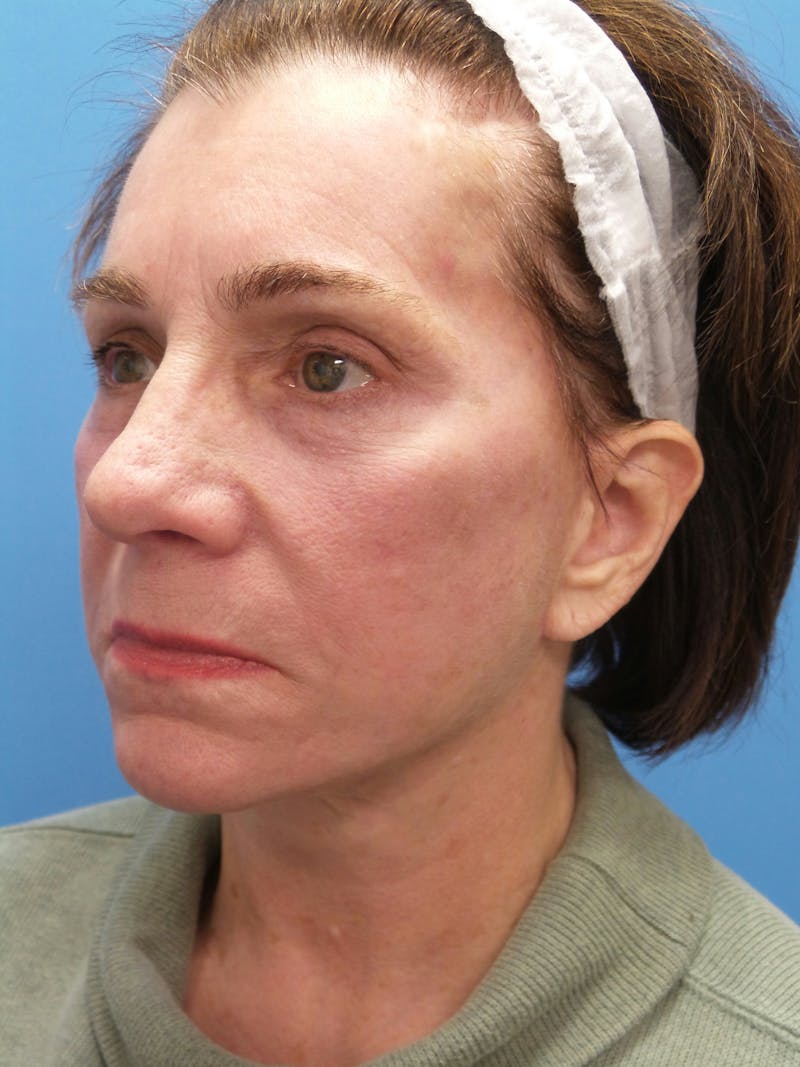 Rhinoplasty Before & After Gallery - Patient 338039 - Image 4