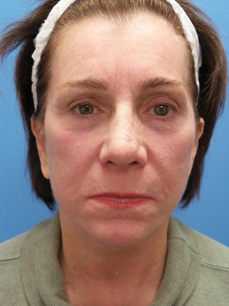Rhinoplasty Before & After Gallery - Patient 338039 - Image 6