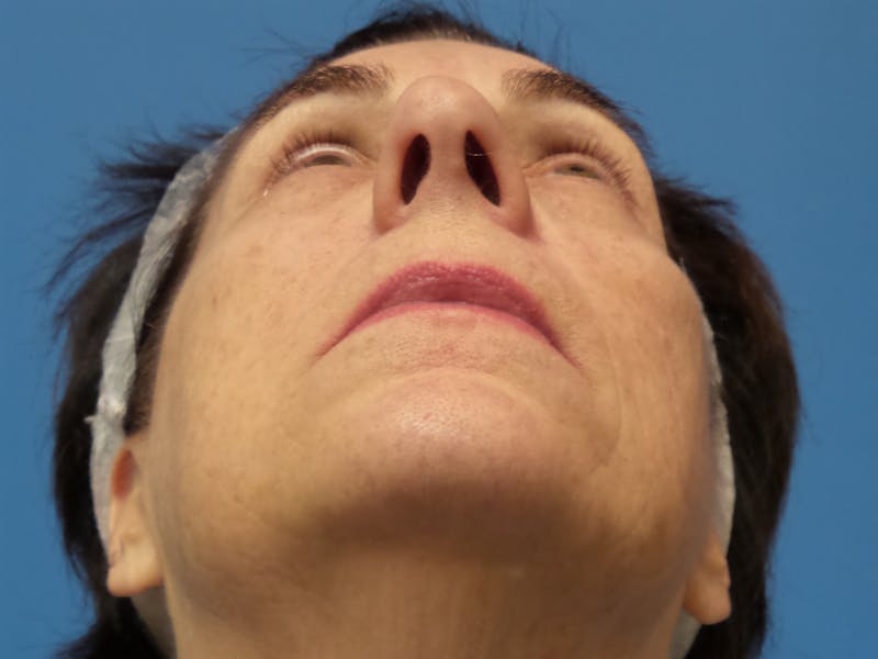 Rhinoplasty Before & After Gallery - Patient 338039 - Image 7