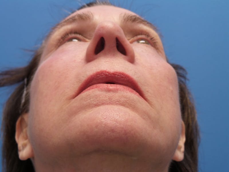 Rhinoplasty Before & After Gallery - Patient 338039 - Image 8