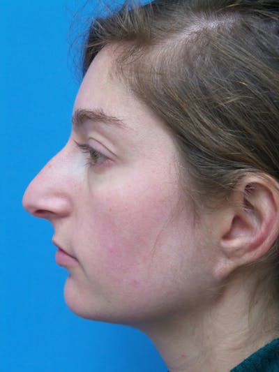 Rhinoplasty Before & After Gallery - Patient 172312 - Image 1