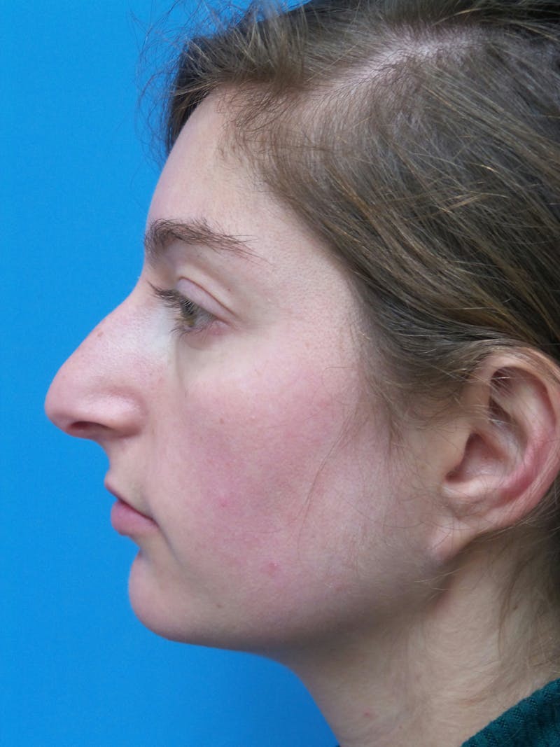 Rhinoplasty Before & After Gallery - Patient 172312 - Image 1