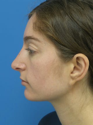 Rhinoplasty Before & After Gallery - Patient 172312 - Image 2