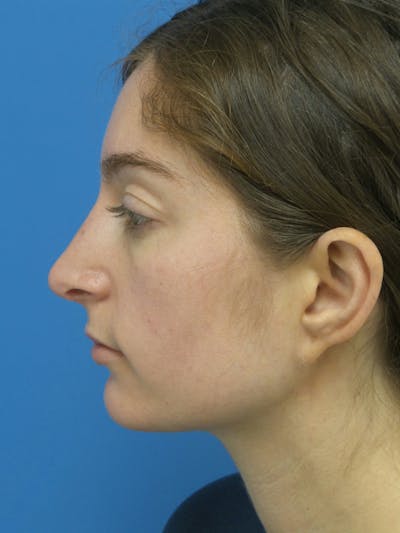 Rhinoplasty Before & After Gallery - Patient 172312 - Image 2