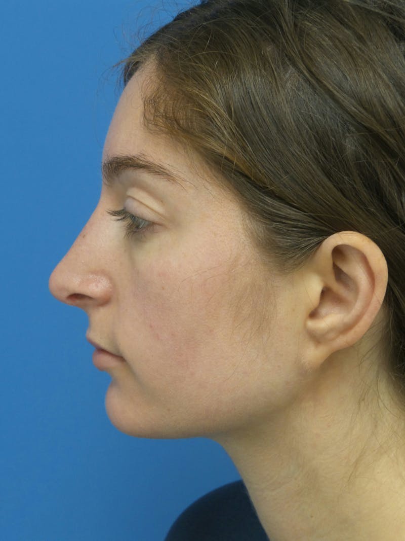 Rhinoplasty Before & After Gallery - Patient 172312 - Image 2
