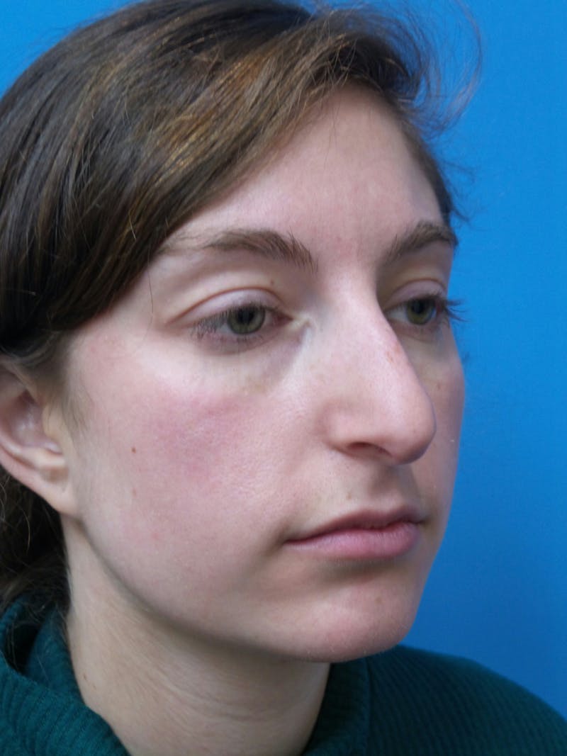 Rhinoplasty Before & After Gallery - Patient 172312 - Image 3