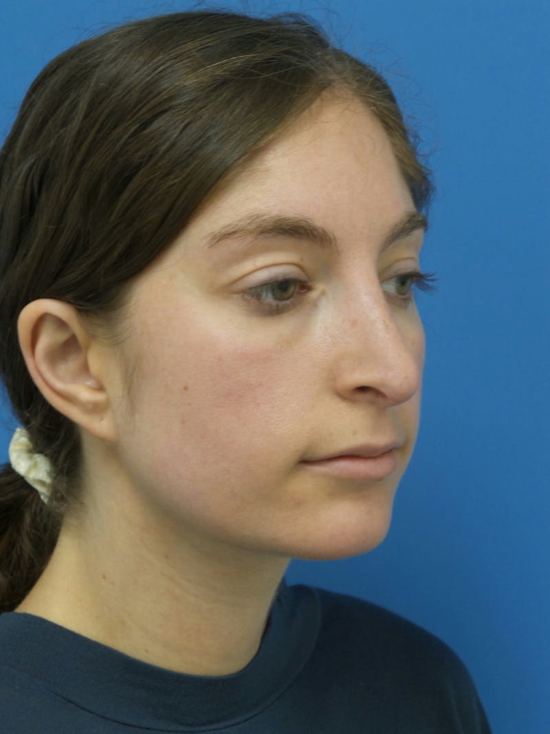 Rhinoplasty Before & After Gallery - Patient 172312 - Image 4